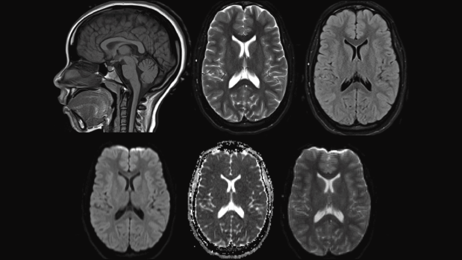 Mri Vs Ct Scan Brain Stroke Ct Scan Machine | My XXX Hot Girl