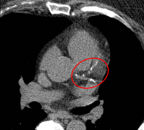 Calcification of Heart Arteries