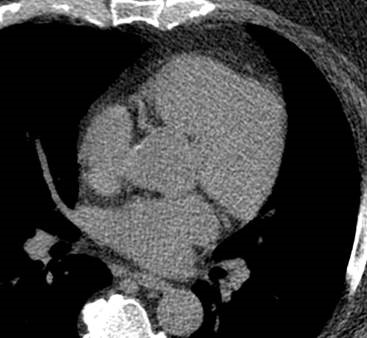 No Calcification of Heart Arteries