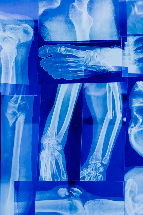 Ortho Fracture WEB