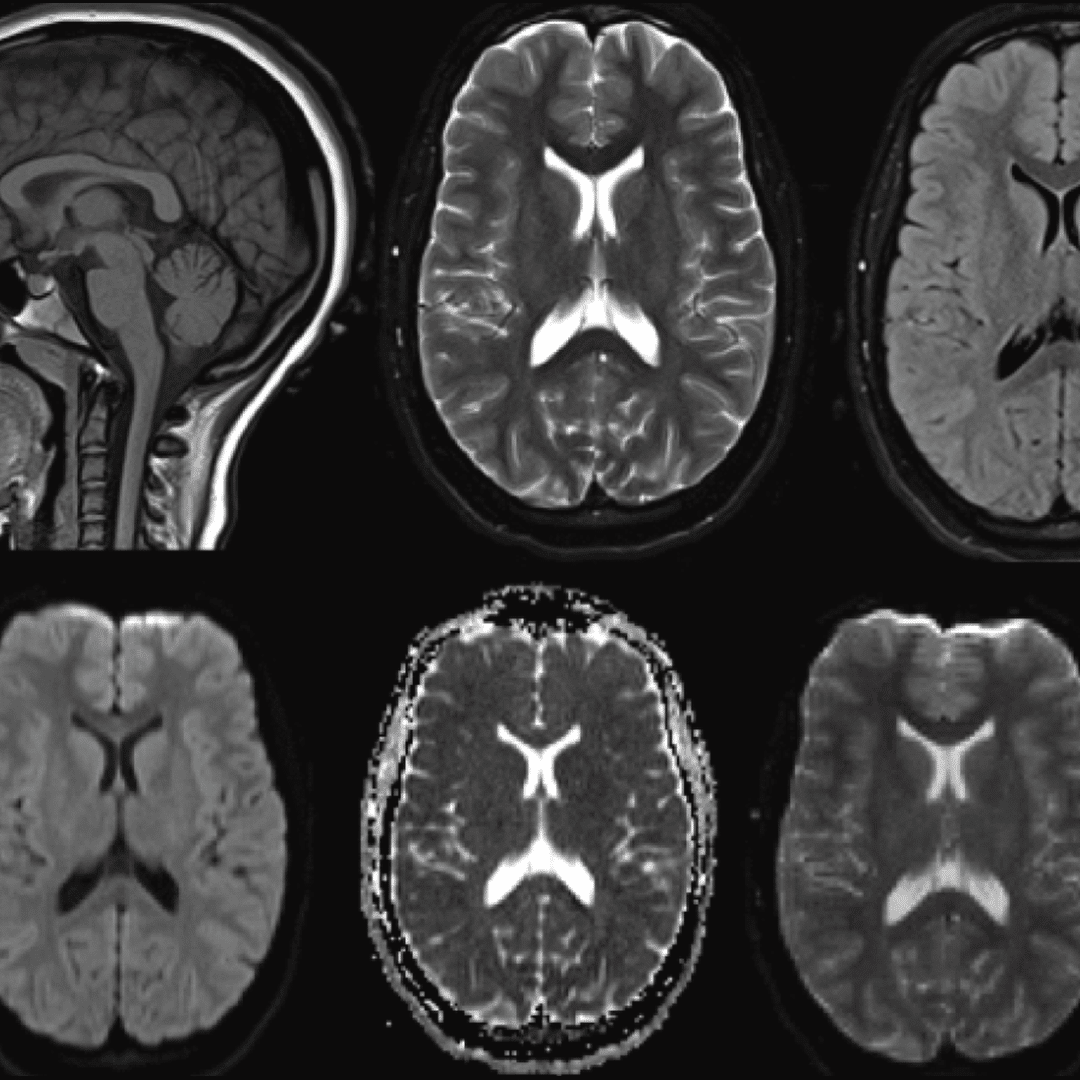 CT vs MRI